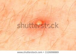 A pustule. From https://www.shutterstock.com/image-photo/purulent-pustule-on-skin-1126098869?src=okW2hsBN1AkZoZtsYKTGPQ-1-2