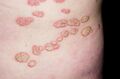 Plaques of psoriasis. From https://fineartamerica.com/featured/5-plaque-psoriasis-on-the-skin-dr-p-marazziscience-photo-library.html