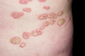 Plaques of psoriasis. From https://fineartamerica.com/featured/5-plaque-psoriasis-on-the-skin-dr-p-marazziscience-photo-library.html