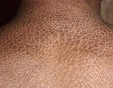 Scaly skin. From https://healthh.com/scaly-skin/